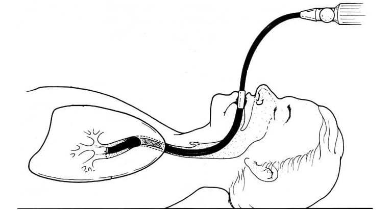 endobronchial-ultrasound-treatmentn