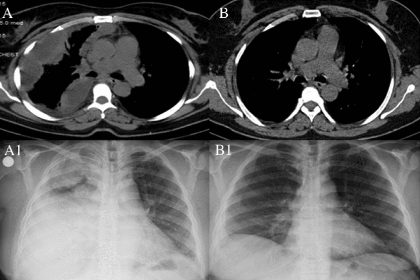 endobronchial-ultrasound-treatmentn