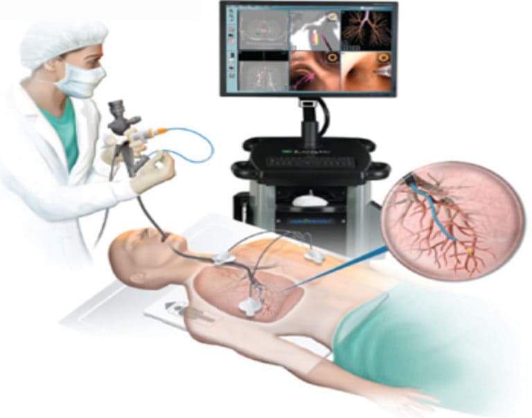 endobronchial-ultrasound-treatmentn