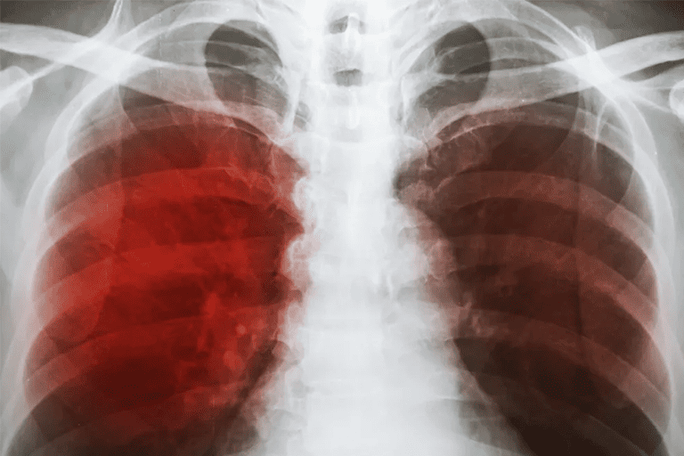 Tuberculosis